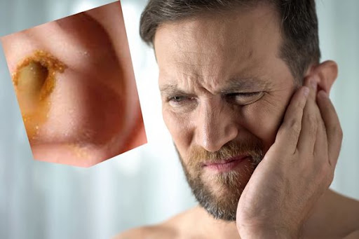 Tai ngứa, chảy nước vàng là biểu hiện của nhiều bệnh lý nhiễm trùng tại tai